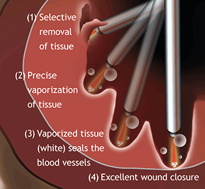Enlarged Prostate Laser Treatment